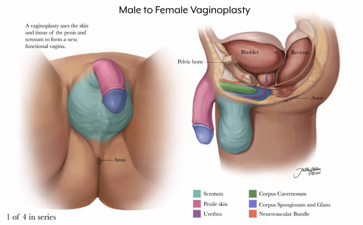 Vaginoplasty 1/4