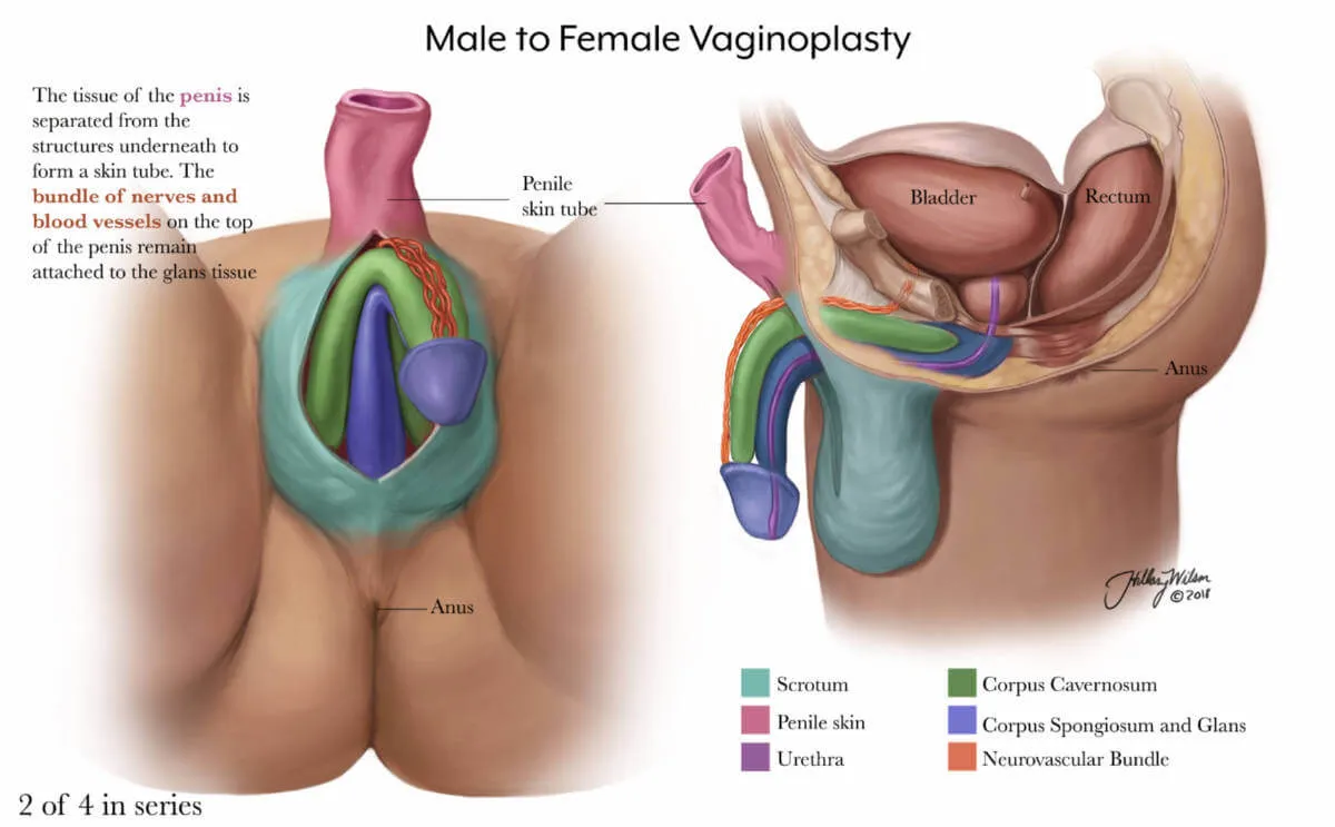 Vaginoplasty 2/4