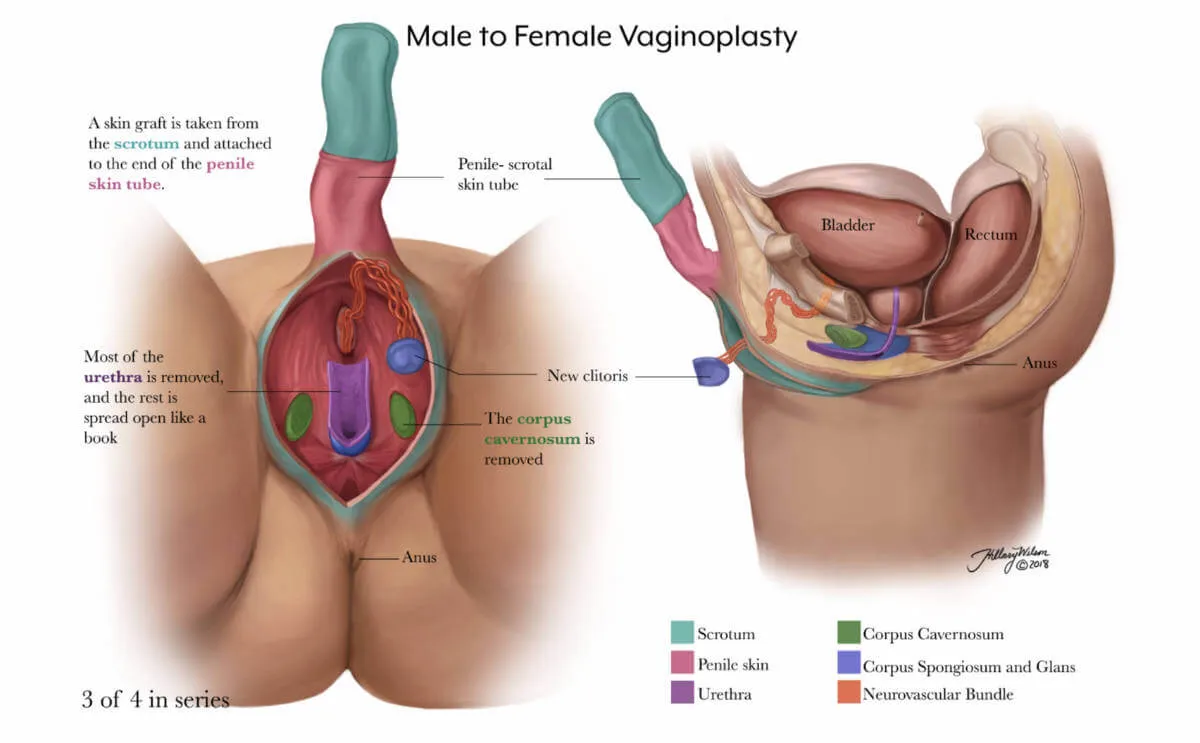 Vaginoplasty 3/4
