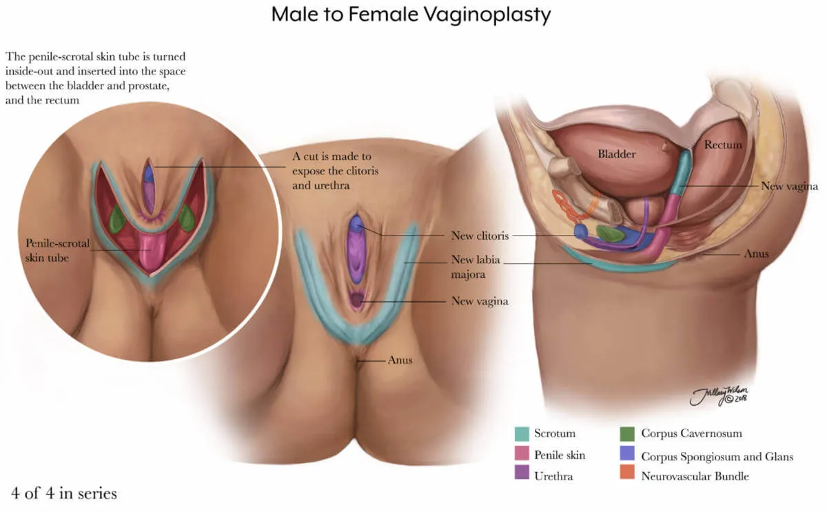 Vaginoplasty 4/4